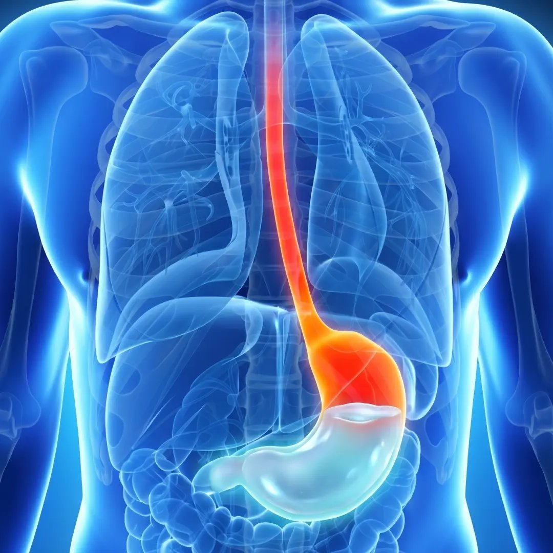 Alivio de la Gastritis